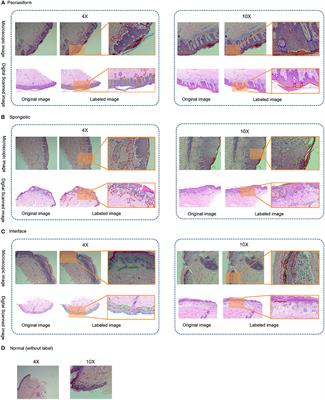 Artificial Intelligence-Aided Recognition of Pathological Characteristics and Subtype Classification of Superficial Perivascular Dermatitis